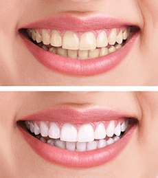 Before and after teeth whitening treatment in Vista